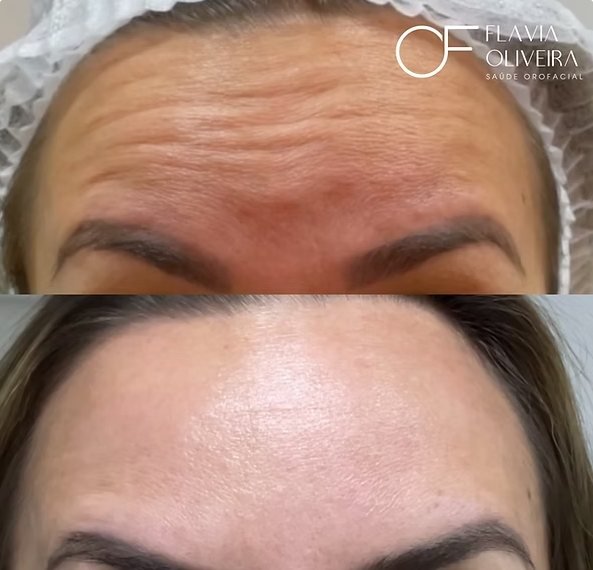 Antes e depois de aplicação de toxina botulínica na testa