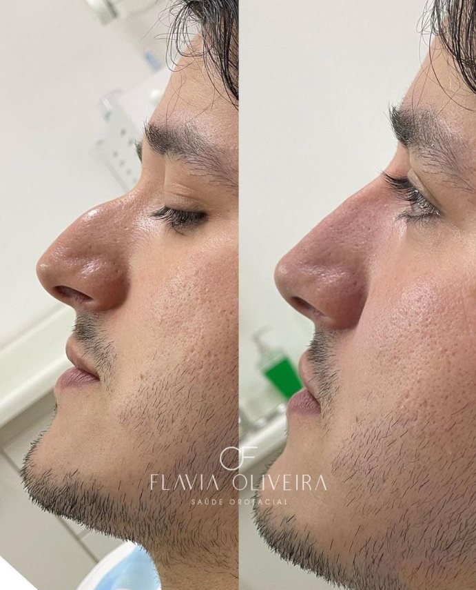 Antes e depois de rinomodelação em perfil masculino
